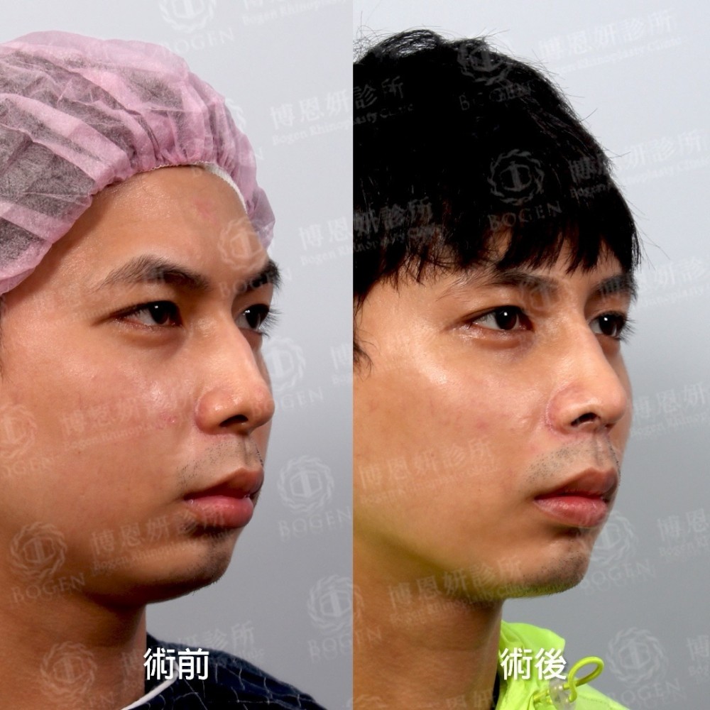 鼻重修推薦,鼻重修醫生,鼻中隔重建,博恩妍